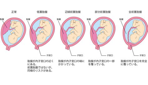 胎盤形成出血|胎盤の重要な役割と前置胎盤などのトラブル